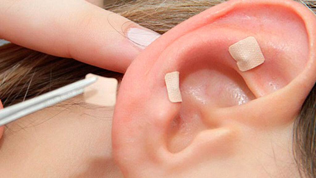 auriculoterapia