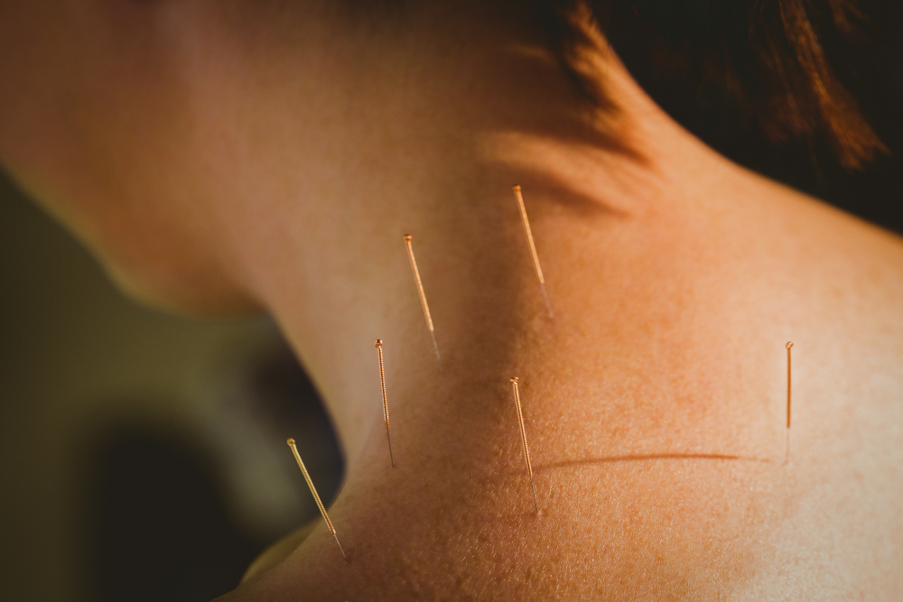 Acupuntura para dor no trapézio e escápula