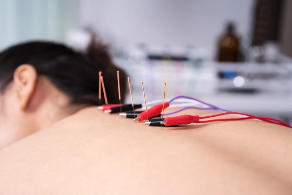 ELETROACUPUNTURA beneficios - DRA MAYARA ALTOMARI