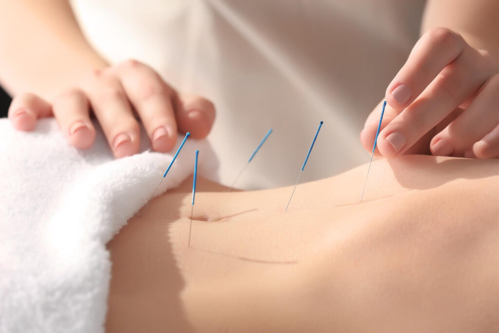 Acupuntura e infertilidade