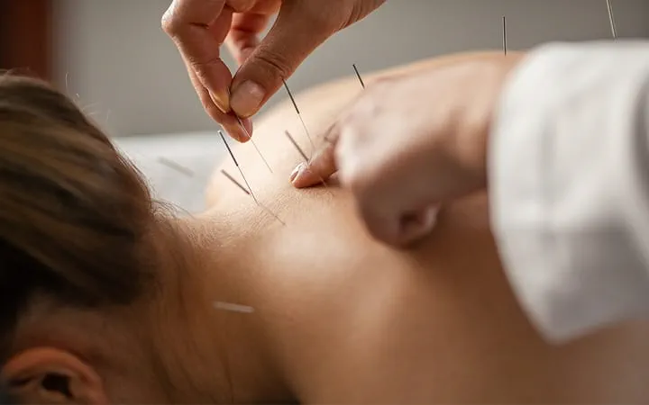 mulher com fibromialgia em sessão de acupuntura com expressão de alívio e relaxamento
