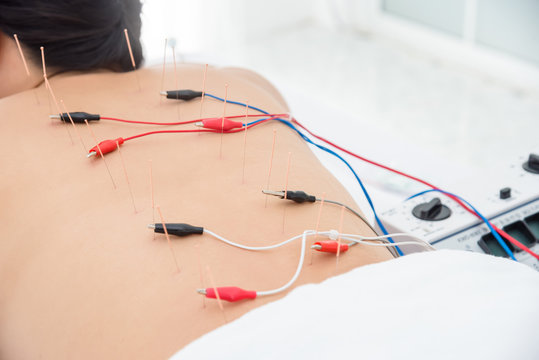 eletroacupuntura em pontos de dor da fibromialgia na região de ombros e costas