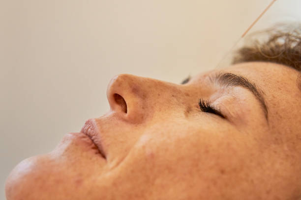 cupuntura ponto yin tang para estresse e relaxamento aplicado na testa